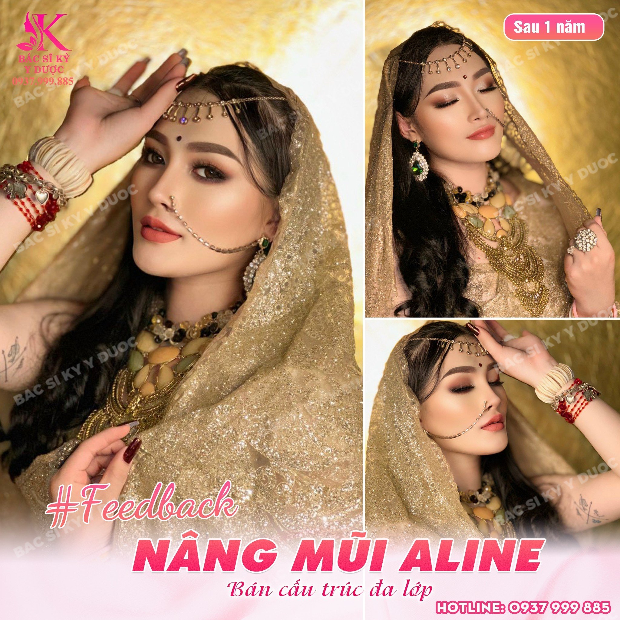 Nâng mũi Aline phù hợp với tỷ lệ gương mặt