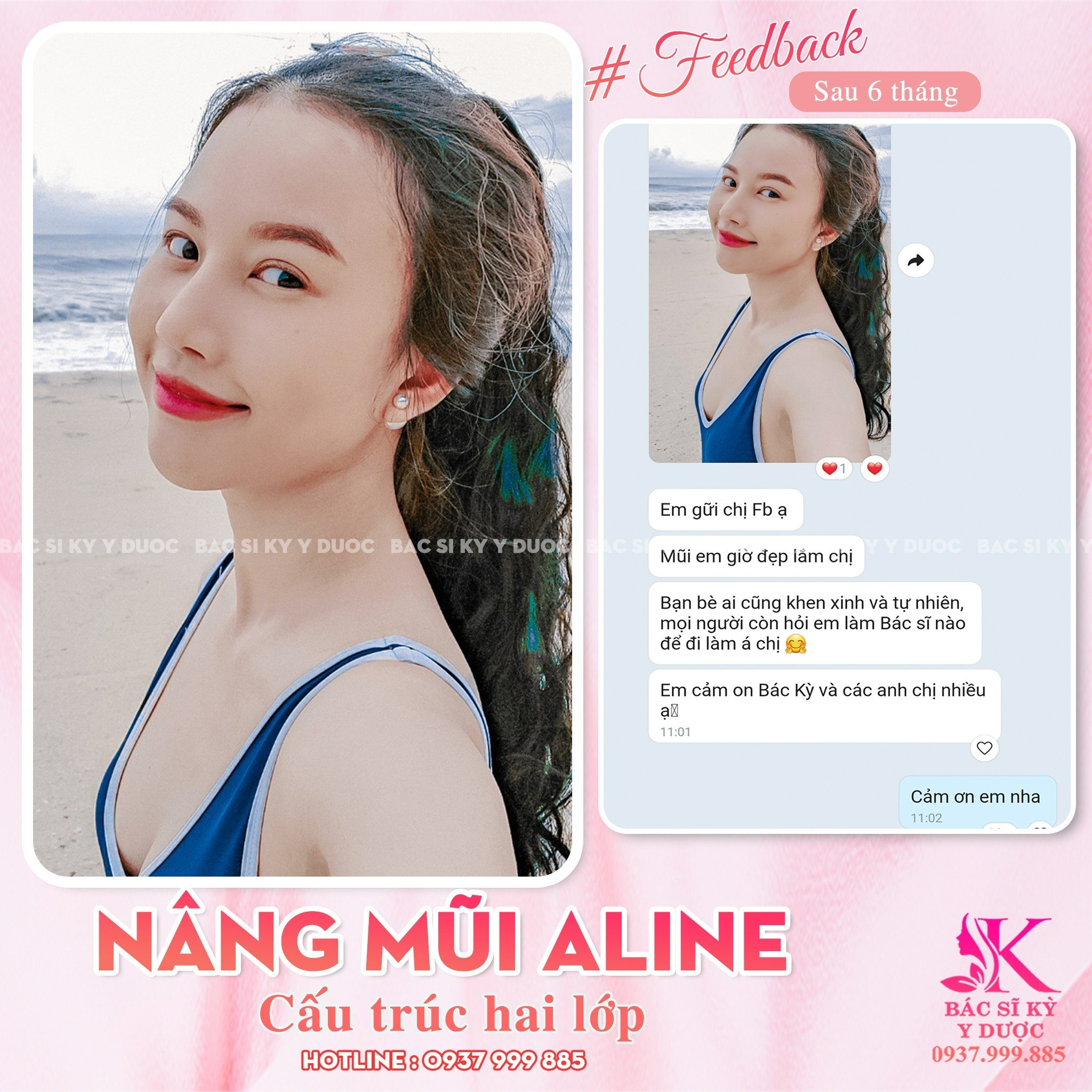 Nâng mũi Aline phù hợp với gương mặt người Việt Nam