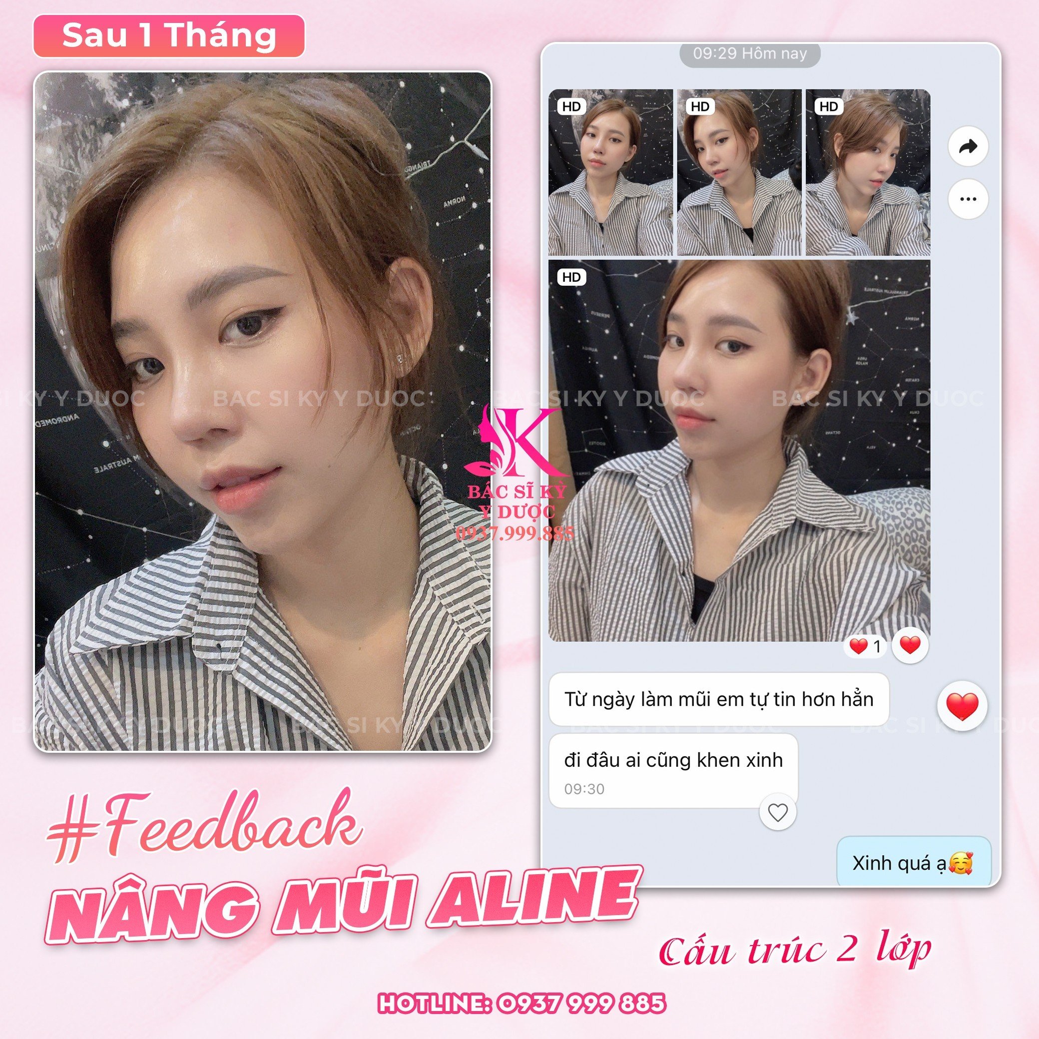 Feedback khách hàng nâng mũi cấu trúc sau 1 tháng