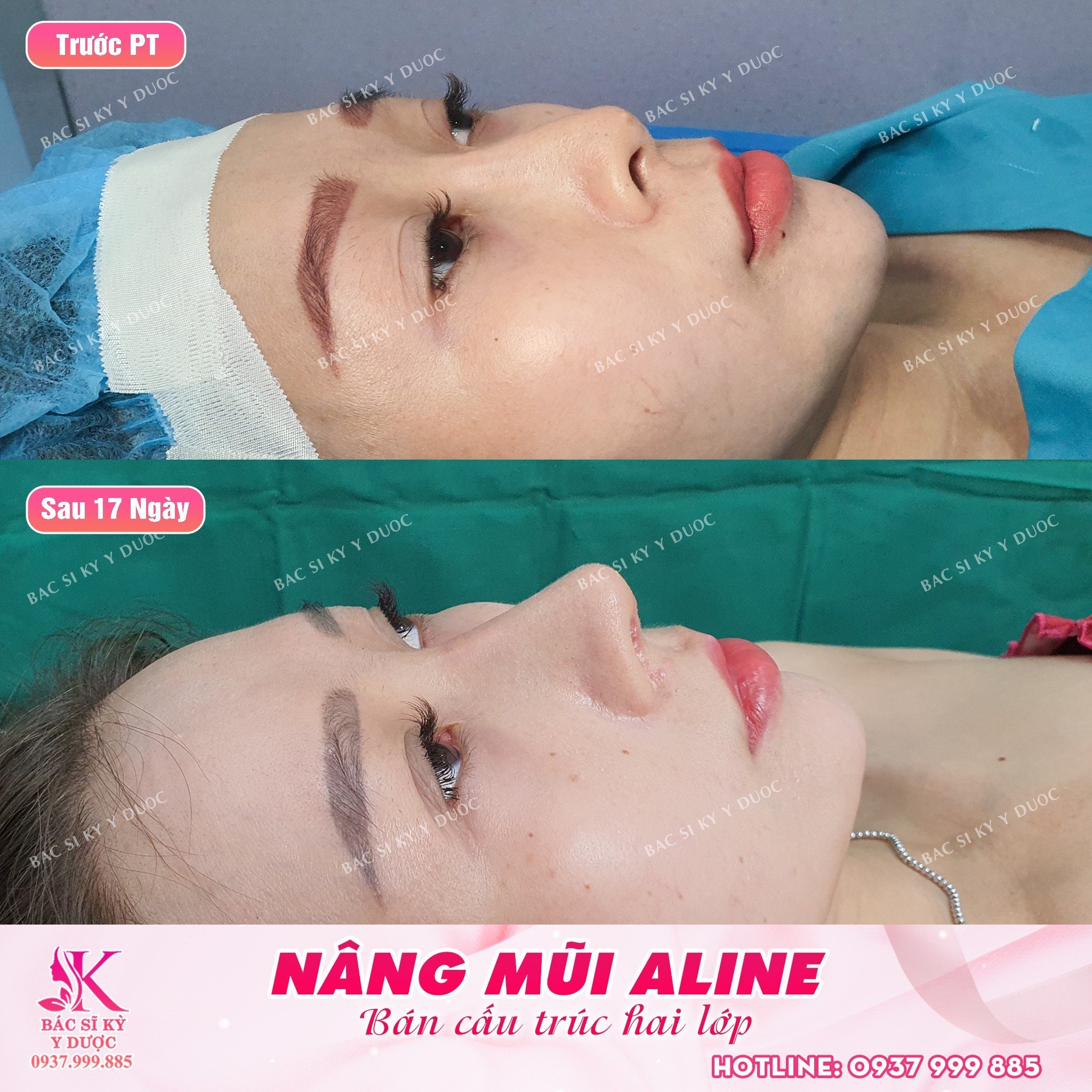 Giải cứu mũi chỉ - Tạo dáng mũi Aline hợp gương mặt