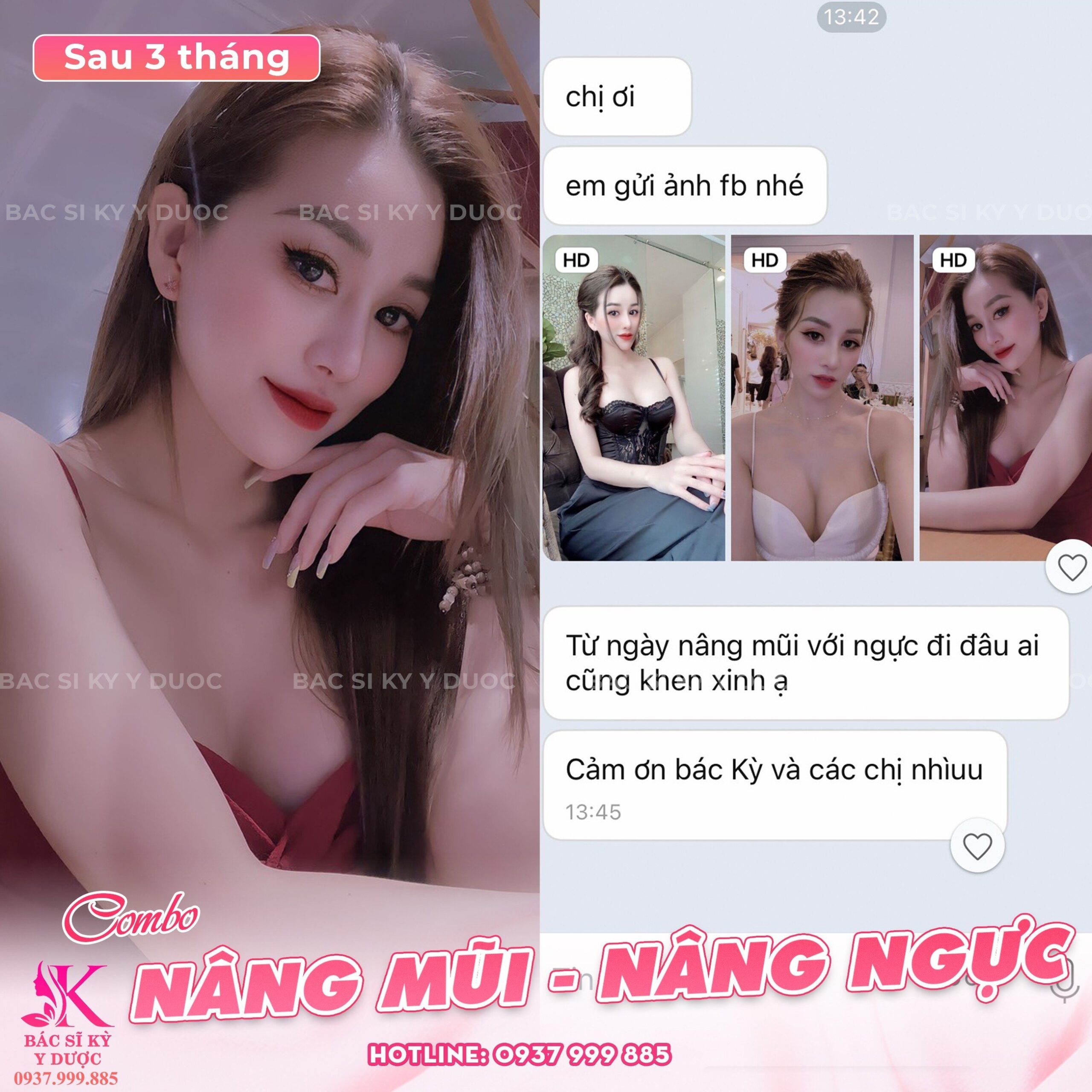 Feedback Nâng mũi Aline - do chính tay Bác sĩ Kỳ Y Dược thực hiện