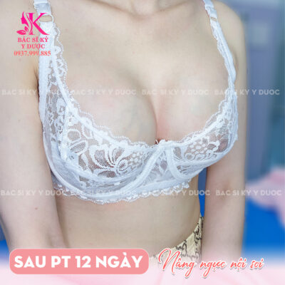 Giá nâng mũi nội soi như thế nào?
