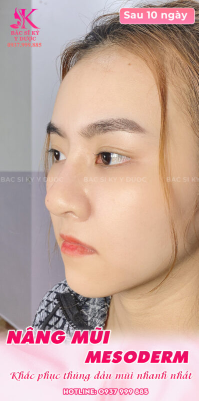 Khắc phục mũi bị tụt sụn bằng mỡ trung bì