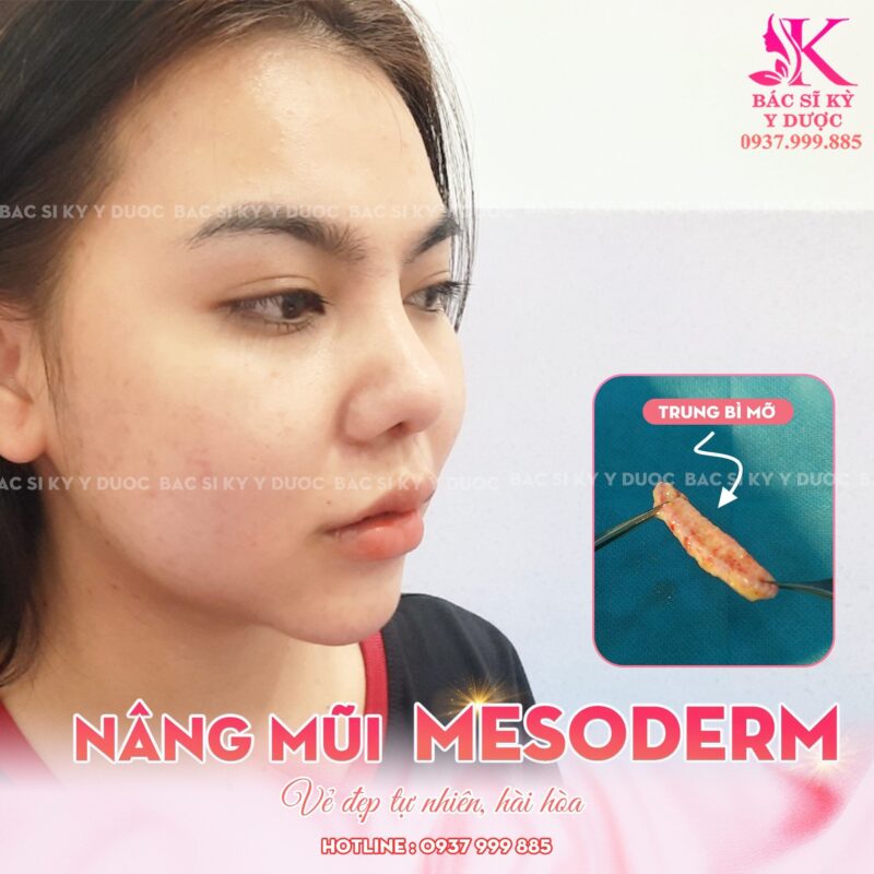 Mỡ trung bì lấy ở đâu