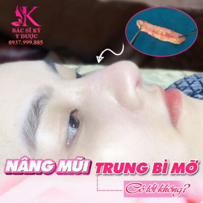 Nâng mũi bằng mỡ trung bì có tốt không