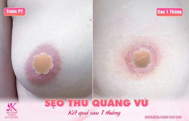 Sẹo thu quầng vú sau 1 tháng