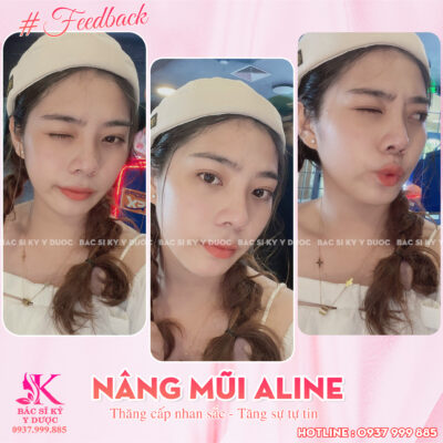 Giá nâng mũi Aline như thế nào là hợp lý