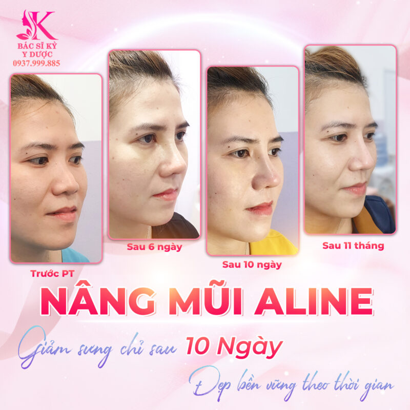 Nâng mũi bao lâu thì đầu mũi mềm