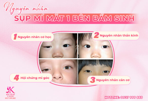 Nguyên nhân sụp mí mắt 1 bên bẩm sinh