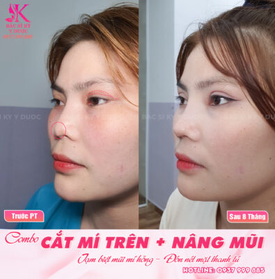Kết quả sau khi cắt mí trên
