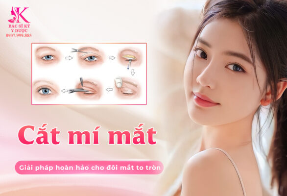 Phẫu thuật mắt mí lót - Giải pháp hoàn hảo cho đôi mắt to tròn
