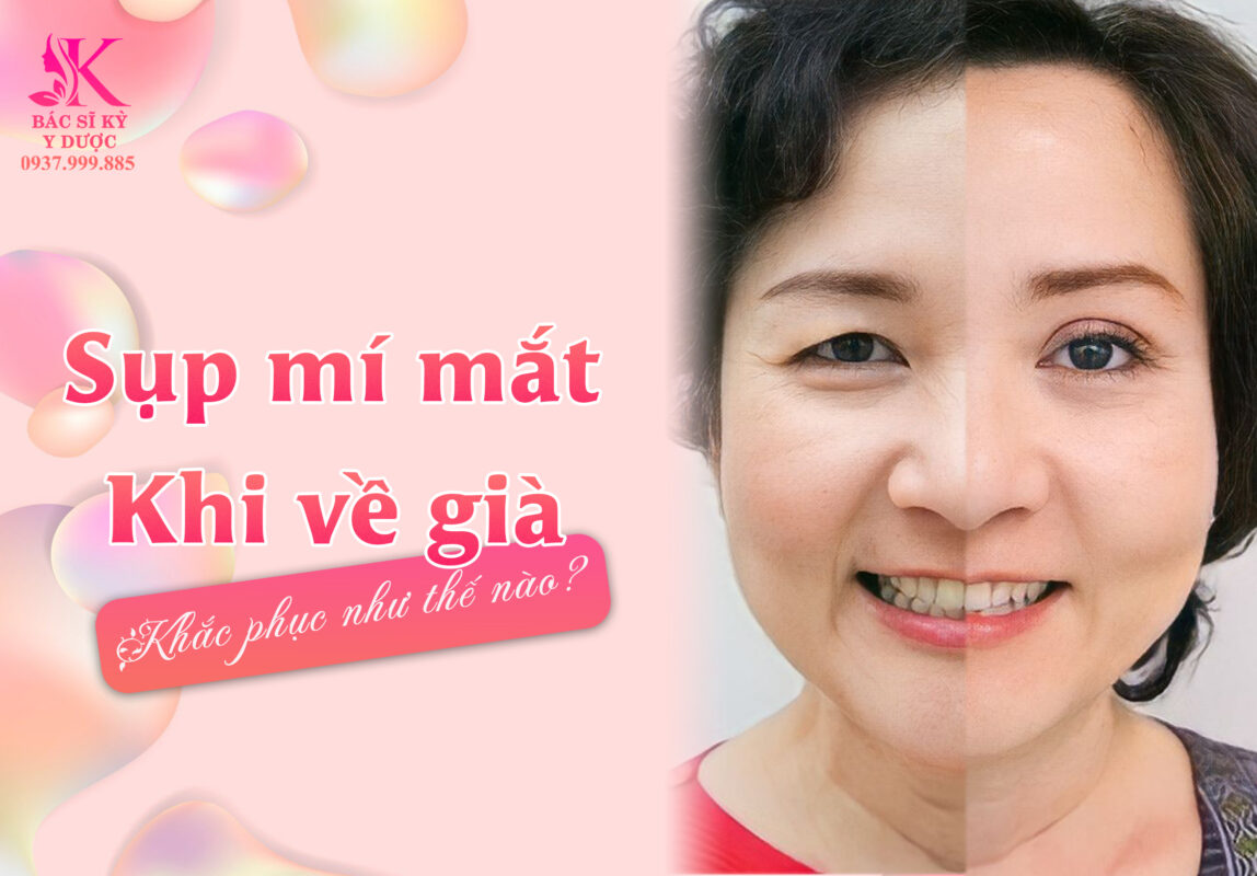 SỤP MÍ MẮT LỚN TUỔI