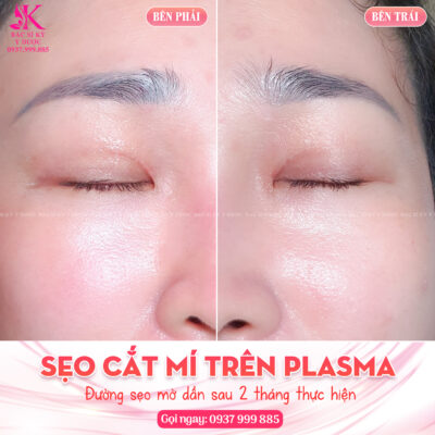 Sẹo cắt mí trên plasma sau 2 tháng và cách chữa sụp mí mắt bẩm sinh