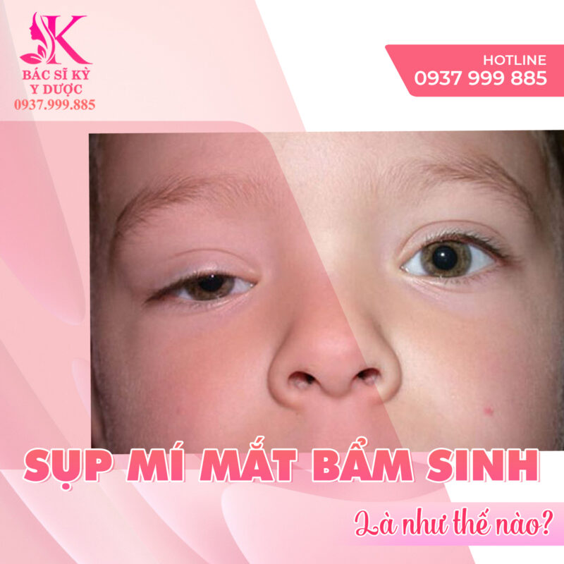Sụp mí mắt 1 bên bẩm sinh là như thế nào