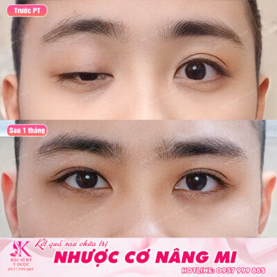 Sụp mí mắt nhược cơ - kết quả điều trị