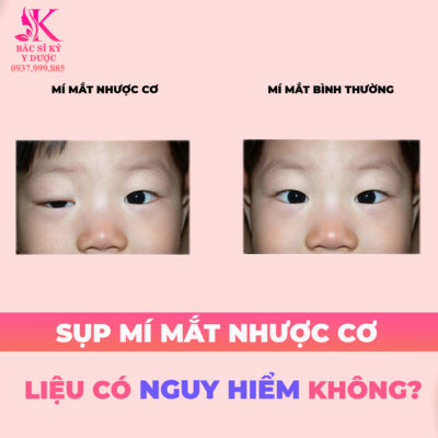Sụp mí mắt nhược cơ phải làm sao