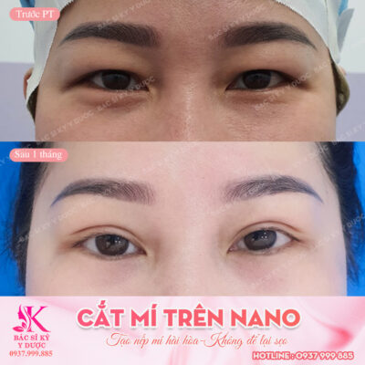 phẫu thuật cắt mí lót
