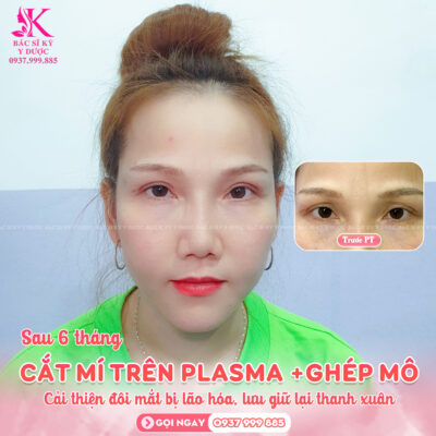 Cách khắc phục da dư thừa mí mắt trên
