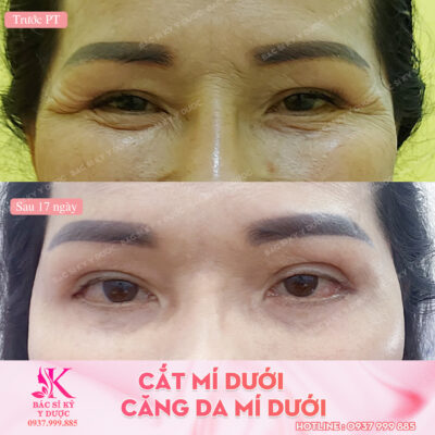 Cắt mí dưới + Căng da mí dưới