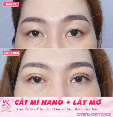 Cắt mắt 2 mí