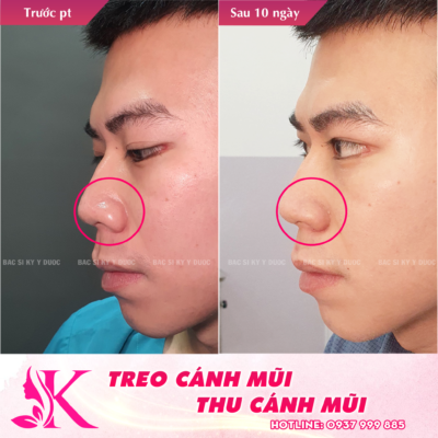 treo cánh mũi