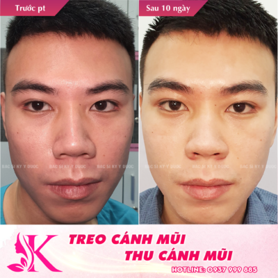treo cánh mũi