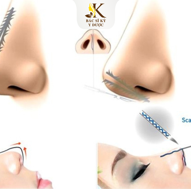 Nâng mũi chỉ collagen