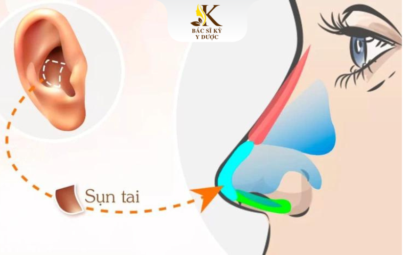 Nâng mũi sụn tai là gì