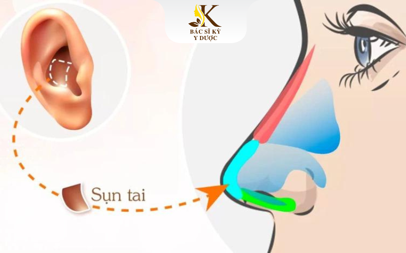 nâng mũi bằng sụn tai được bao lâu