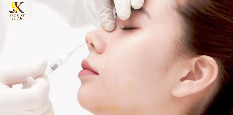 Nâng mũi chỉ Hiko là gì
