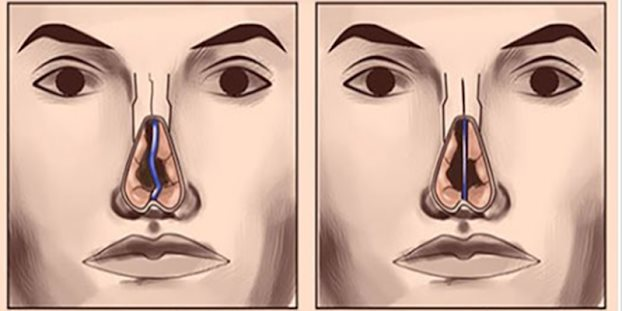 Hậu quả của nâng mũi khi về già