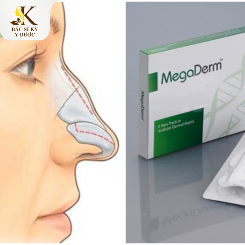 Nâng mũi bọc sụn Megaderm