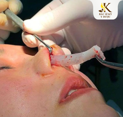 Nâng mũi cấu trúc tháo ra được không?