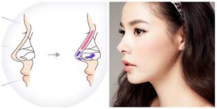 Nâng mũi dùng vật liệu sụn nhân tạo