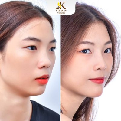 Nâng mũi bằng chỉ Collagen là gì?