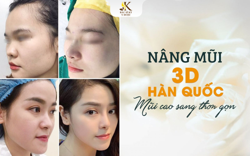 Nâng mũi S Line 3D là gì