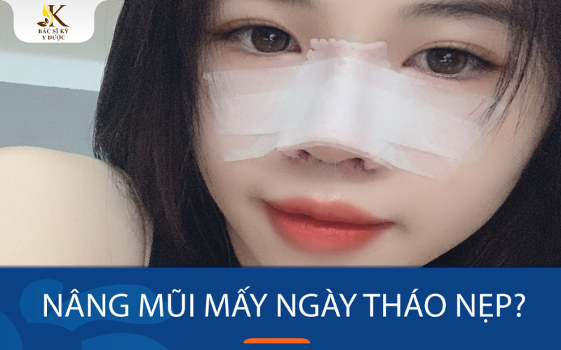 Nâng mũi mấy ngày tháo nẹp