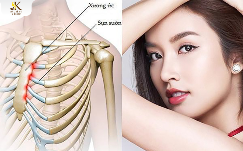 Sụn sườn