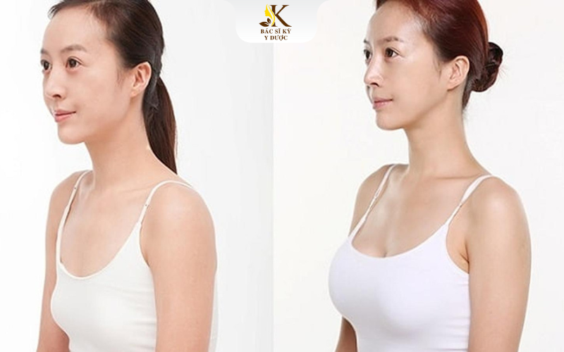 Nâng ngực bằng mỡ tự thân