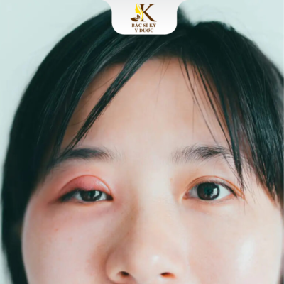 Cắt mí hỏng có sửa được không?