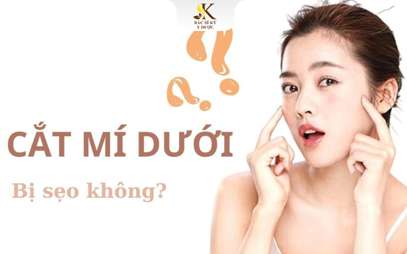 Cắt mí dưới có sẹo không