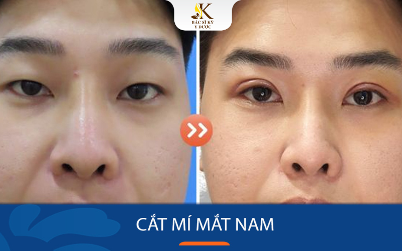 Cắt mắt 2 mí nam giới