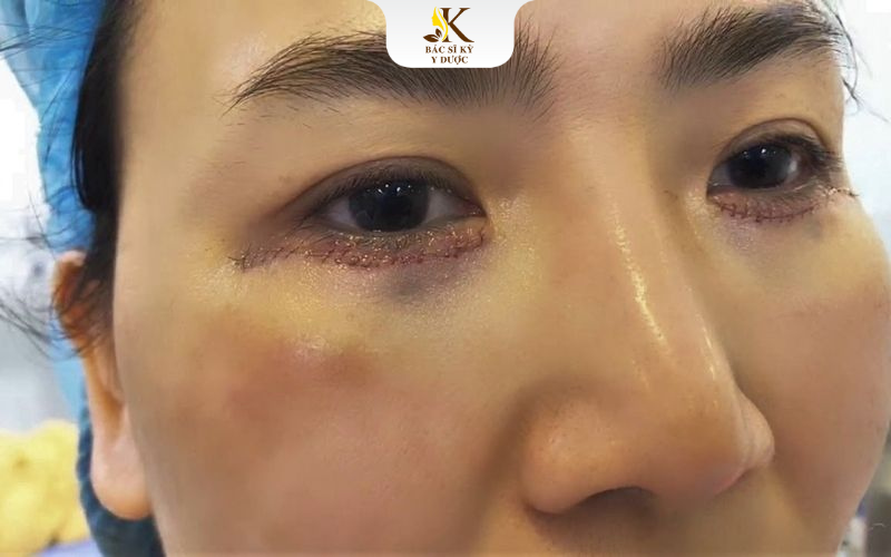 Chăm sóc sau khi cắt mắt mí dưới