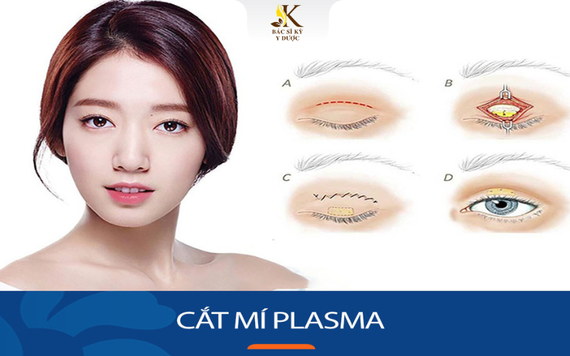 Cắt mí Plasma