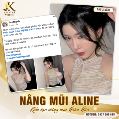 Nâng mũi cao Tây tại Bác sĩ Kỳ Y Dược