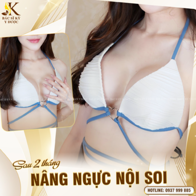 Nâng ngực nội soi là gì?