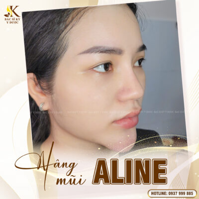 Nâng mũi xong bị thấp lại? Kết quả sau khi Nâng mũi Aline tại Bác sĩ Kỳ Y Dược