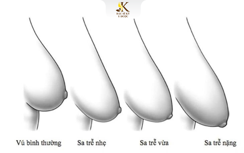 Ngực sa trễ