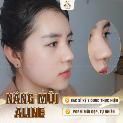 Nâng mũi xong bị thấp lại? Kết quả sau khi Nâng mũi Aline tại Bác sĩ Kỳ Y Dược