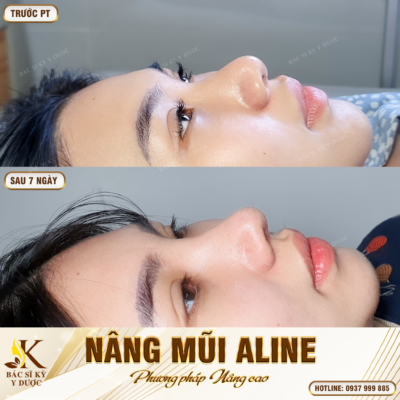 Nâng mũi xong bị thấp lại? Kết quả sau khi Nâng mũi Aline tại Bác sĩ Kỳ Y Dược